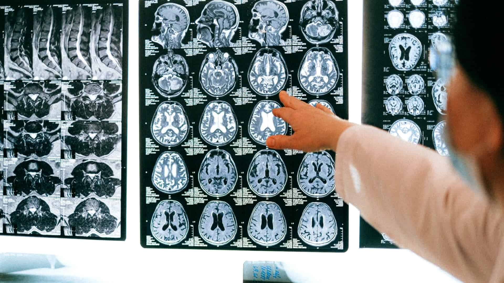 Foto på läkare som pekar på skiktröntgenbilder av en persons hjärna.