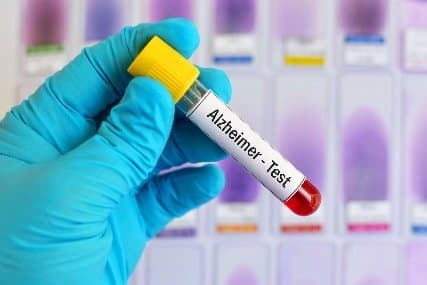 Hand som håller i ett provrör med en etikett där det står "Alzheimer - Test".