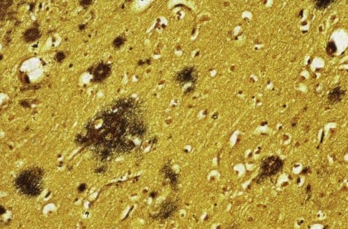 Hjärnvävnad från en patient med Alzheimers sjukdom.