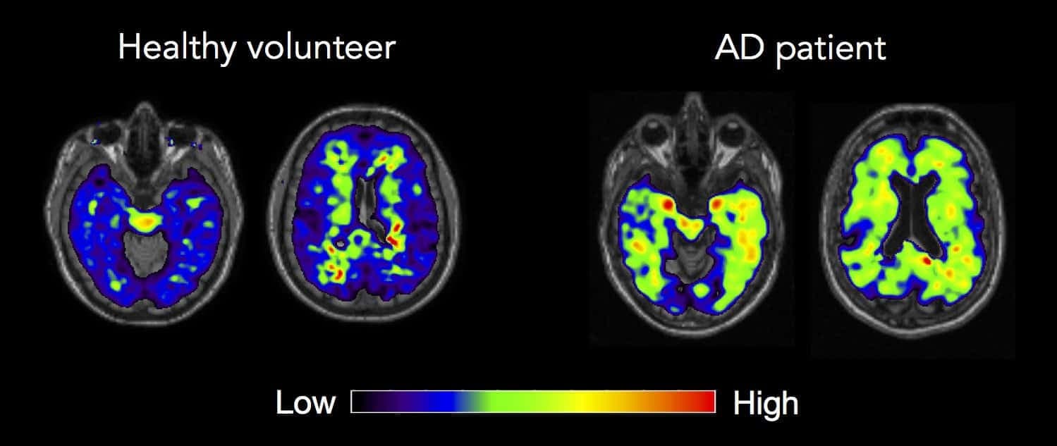Jämförande hjärnbilder från en frisk försöksperson och en patient med Alzheimers sjukdom, där färgerna visar olika signalnivåer.