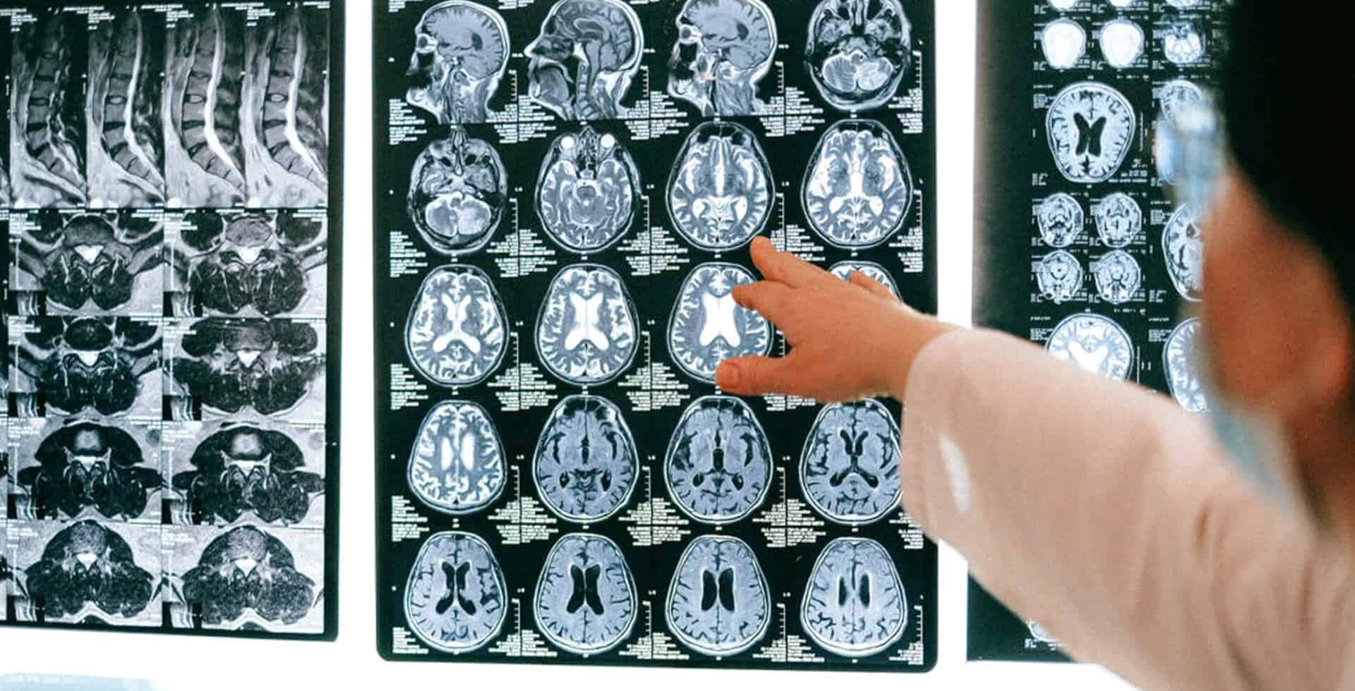 Foto på läkare som pekar på skiktröntgenbilder av en persons hjärna.