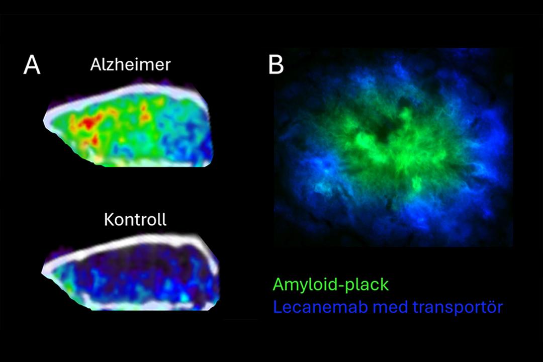 amyloid beta.