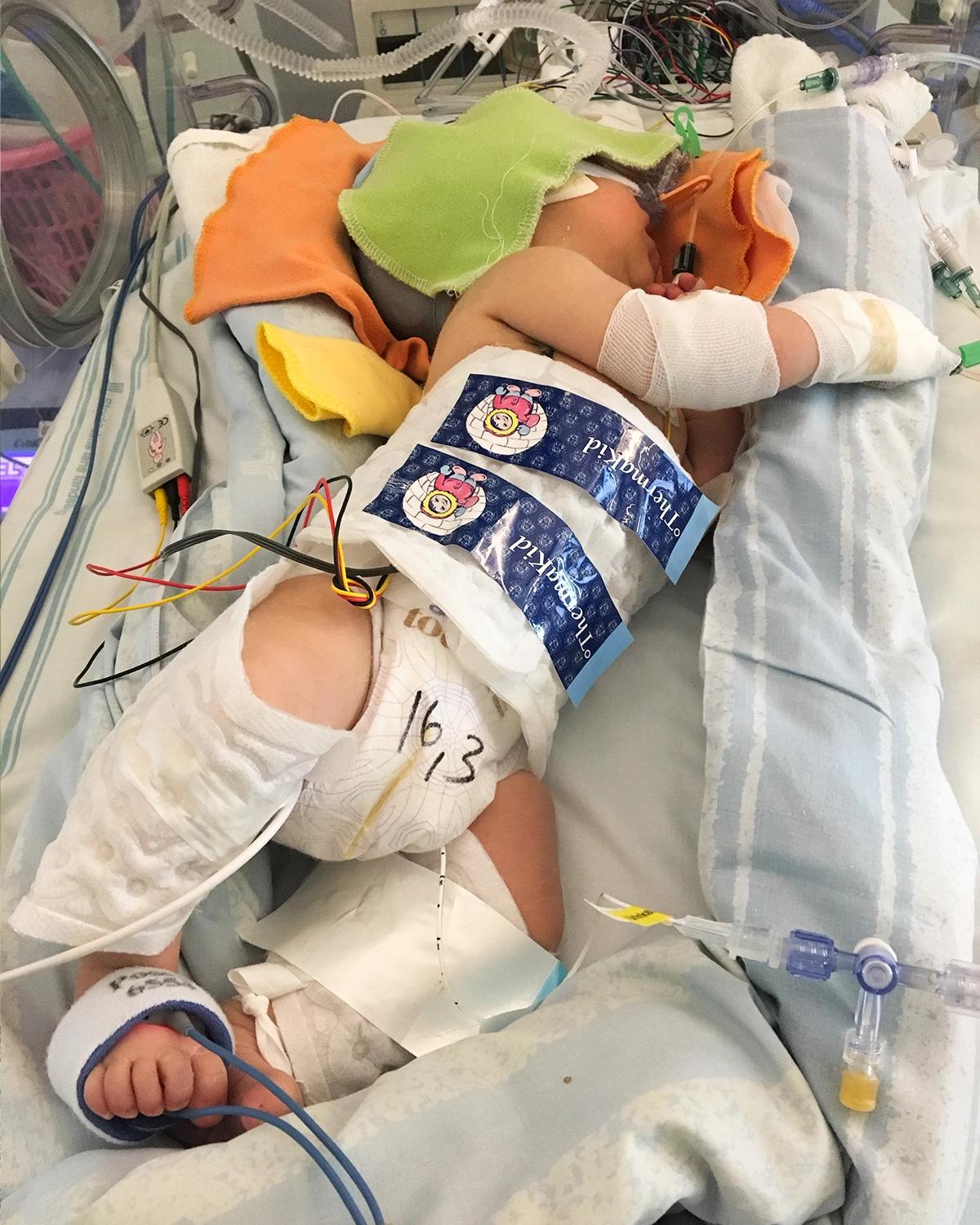 Sophie som nyfödd på neaonatalen, med slangar och bandage.