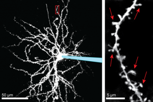 Den övre bilden visar en nervcell i striatum. Samtliga cellens förgreningar och taggar syns eftersom cellen fyllts med ett fluorescerande färgämnet genom en glaspipett (som visas i blått). I den nedre bilden pekar de röda pilarna på cellens taggar. Foto: Tim Fieblinger och Angela Cenci Nilsson