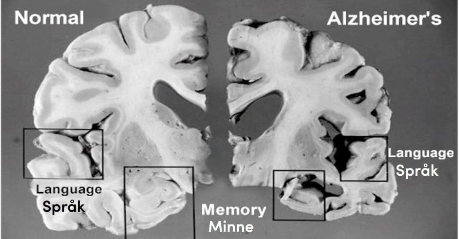 Yläosa 66+ imagen vilket minne påverkas först vid alzheimers sjukdom