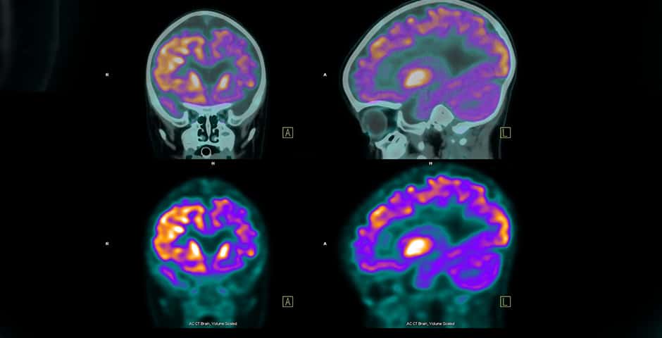 Avbildning av hjärnan med PET