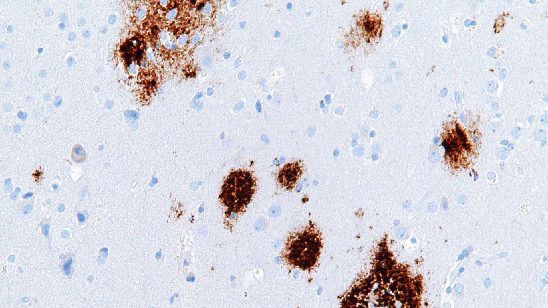 Bilden visar amyloida plack (syns i brunt). Vid Alzheimers sjukdom bildas små klumpar vid nervtrådarna, så kallade amyloida plack, som stör kommunikationen mellan nervcellerna. Placken består främst av beta-amyloid, ett protein som även förekommer i en frisk hjärna.