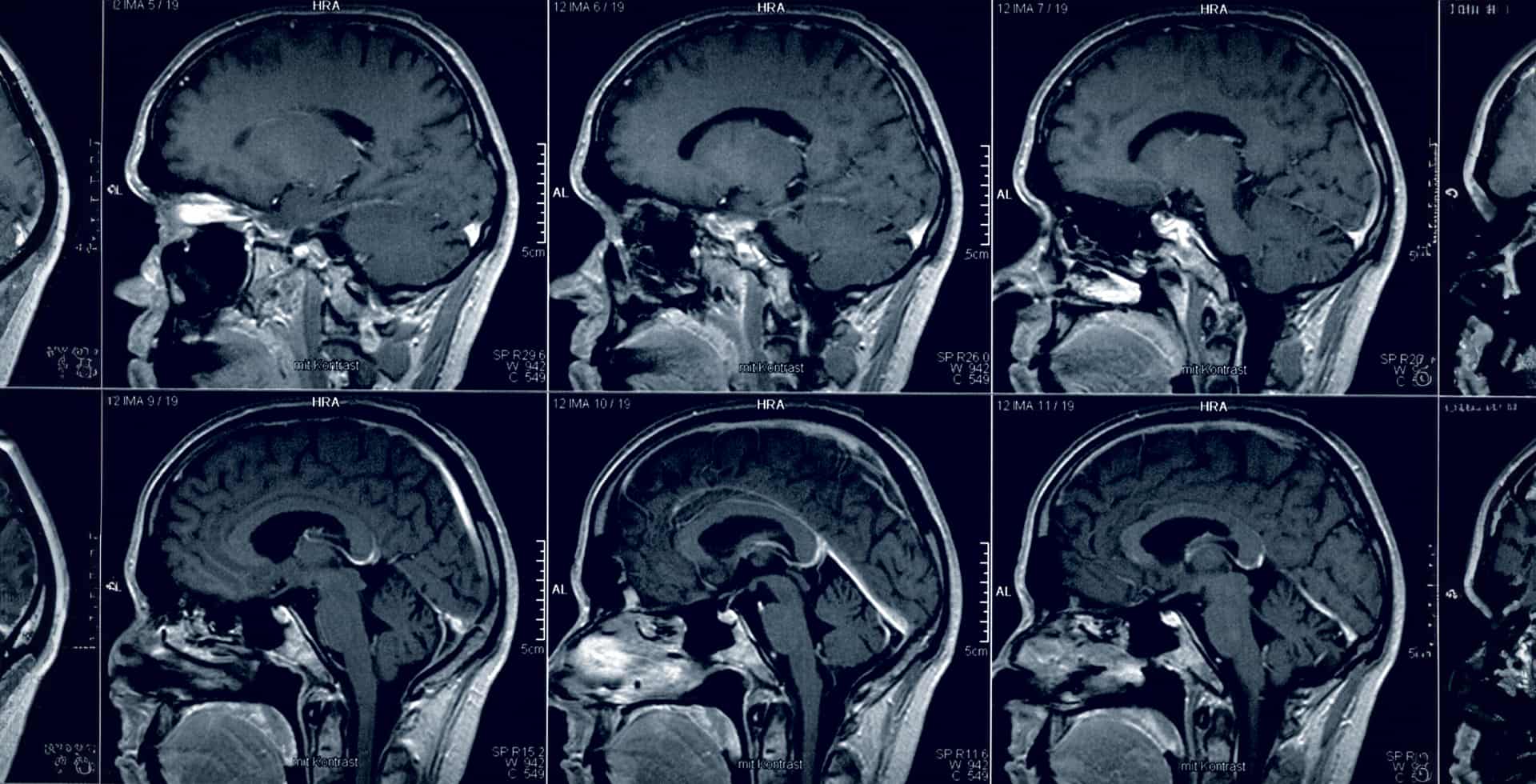 Magnetisk resonanstomografi (MRI) av en hjärna.